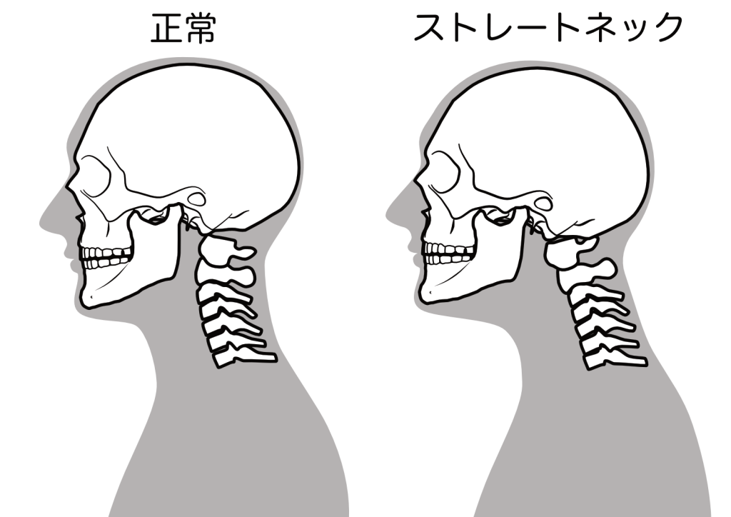 ストレートネックのイメージ